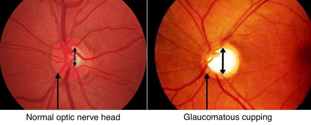 Glaucoma project mockup
